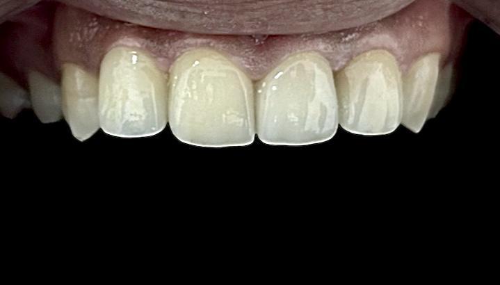 After: full arch veneer transformation