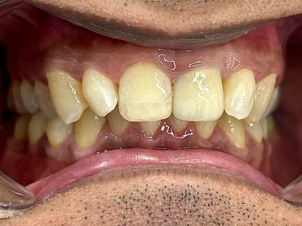 After: tooth-coloured zirconia crown replacing old metal crown