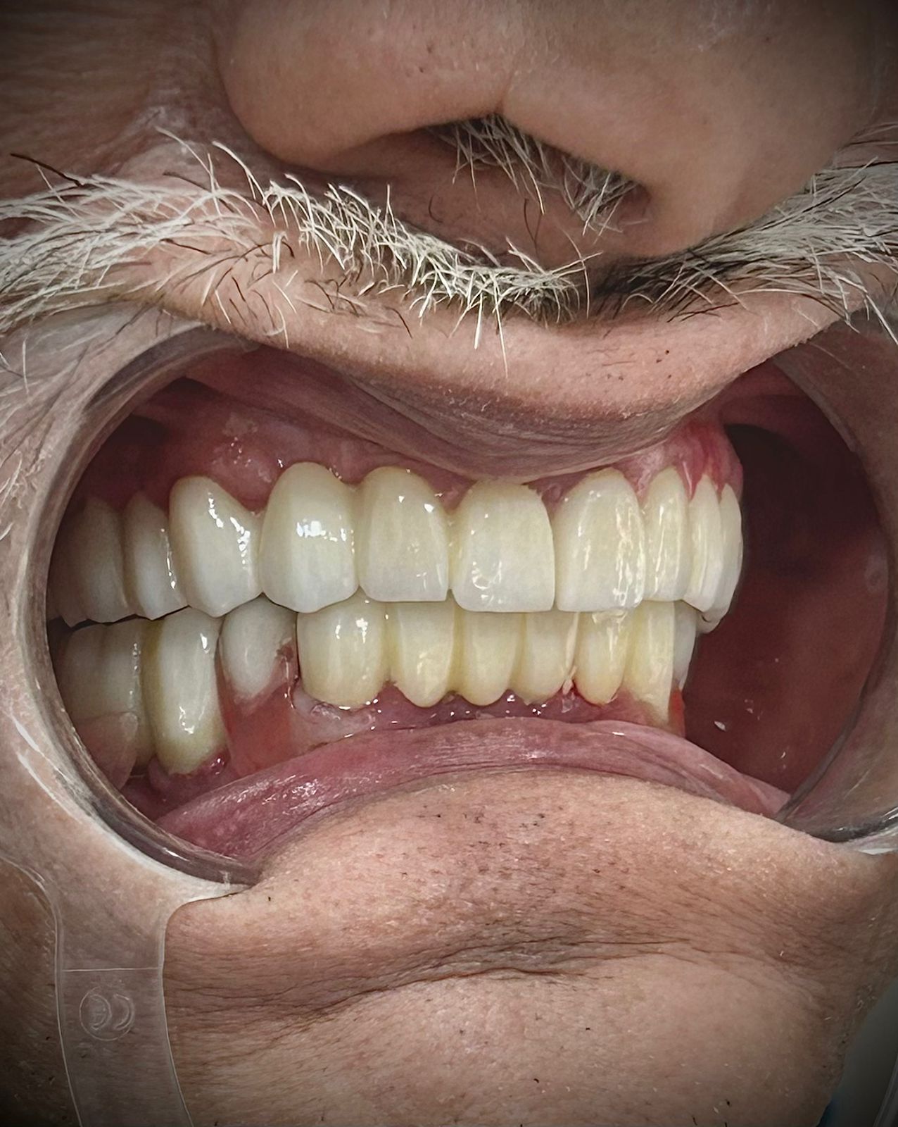 After: complete full mouth rehabilitation with ceramic crowns and bridges