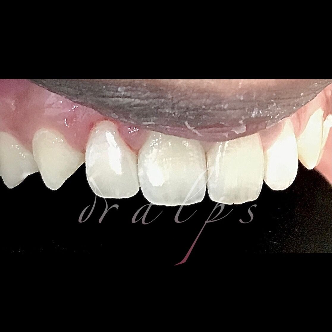 After: tooth-coloured composite restoration on upper lateral incisor