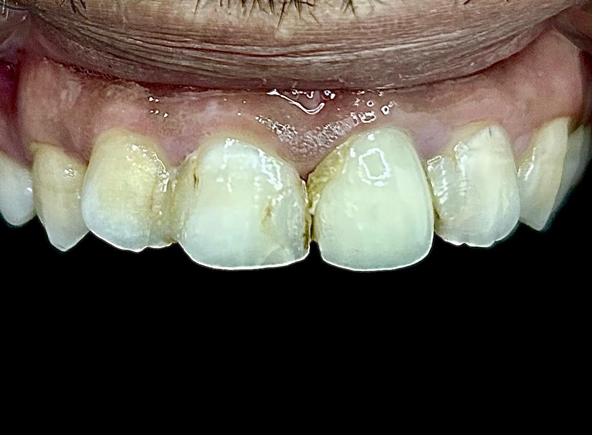 Before: discoloured and uneven teeth