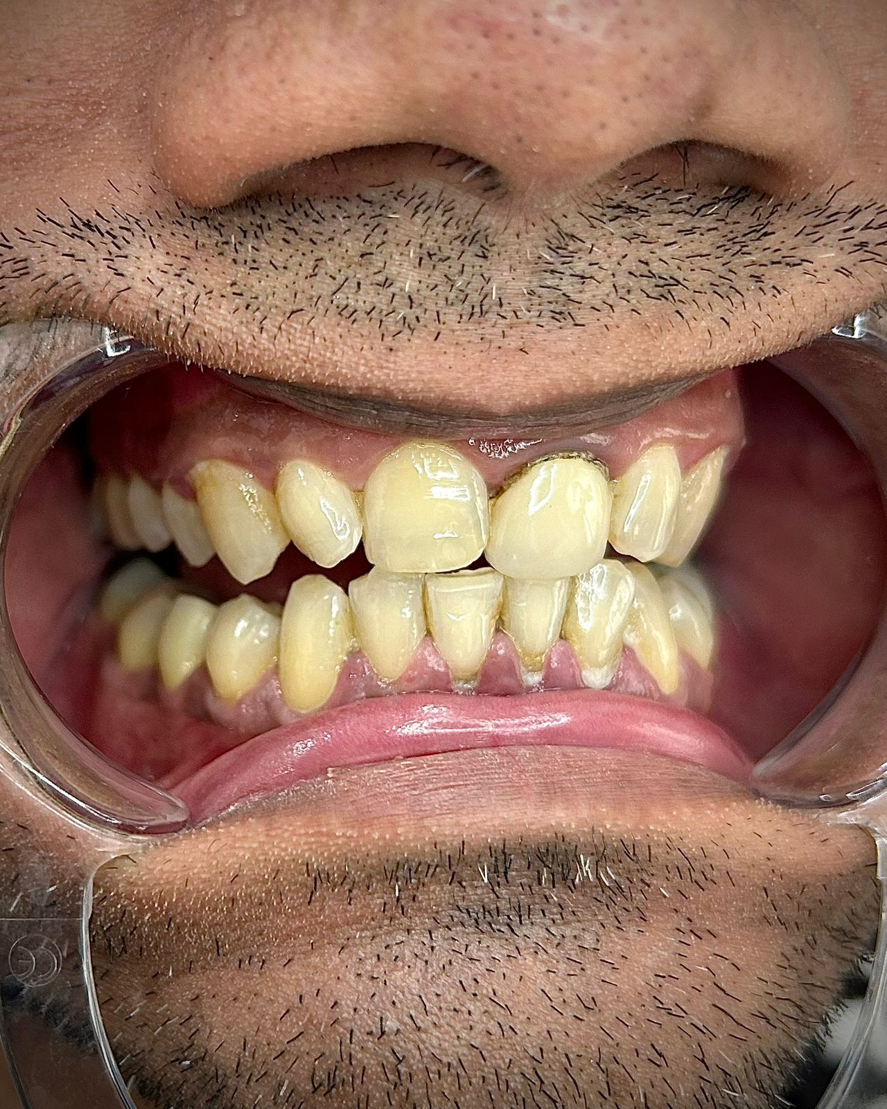 Before: old discoloured metal crown on upper front tooth