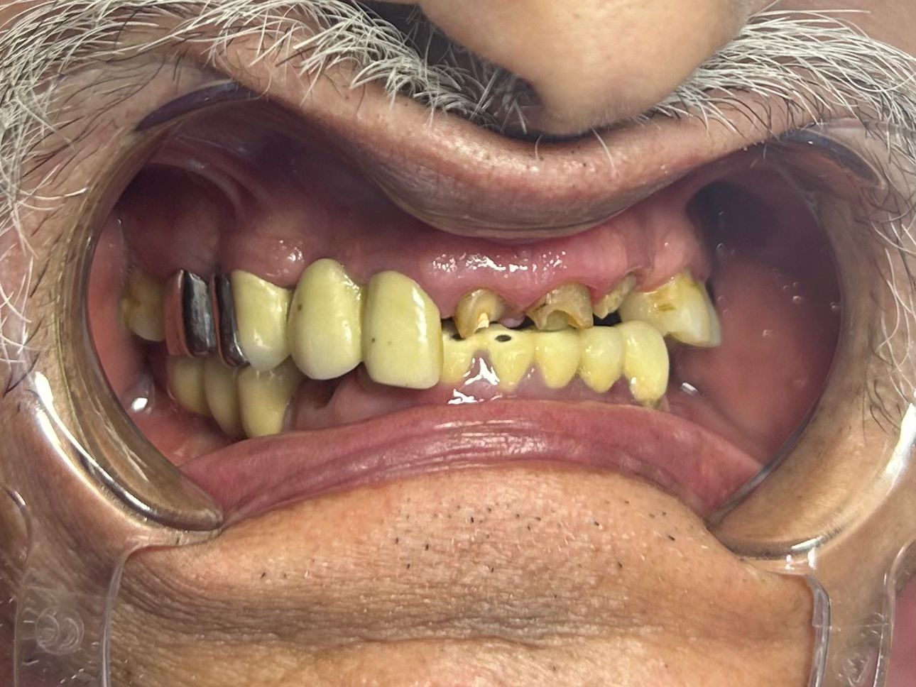 Before: severely decayed and missing teeth