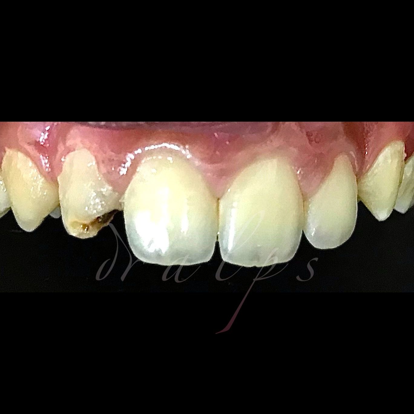 Before: deep cavity and decay on upper lateral incisor